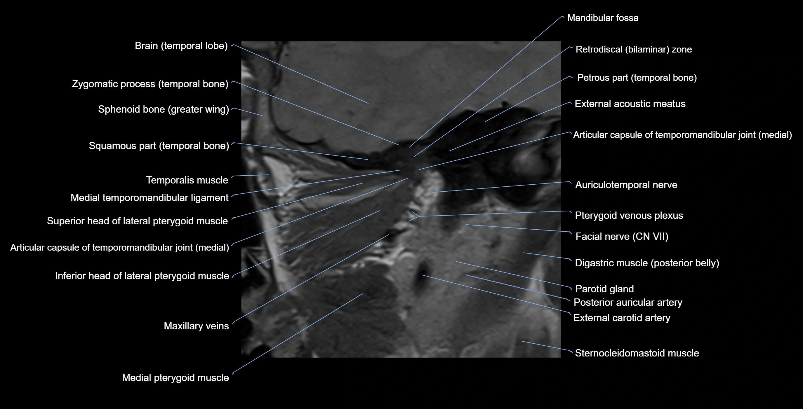 MRI TMJ sagittalclosed  mouth cross sectional 3T anatomy -img-00001-00012.webp